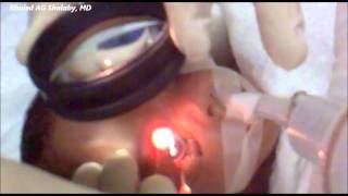 Laser Treatment of Retinopathy of prematurity ROP [upl. by Hildick]