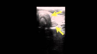 ultrasound intubation [upl. by Ynohtn]