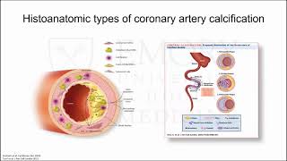 Coronary Artery Calcification When Artery Becomes Bone [upl. by Beatty]