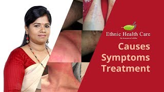 ஆண்களுக்கு ஏற்படும் தோல் நோய் எக்ஸிமாகரப்பான் நோய்அரிப்பு Skin Problem Eczema Karappan Disease [upl. by Oek]