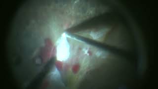 Surgery for PDR with Combined Traction Rhegmatogenous Retinal Detachment [upl. by Aileen]