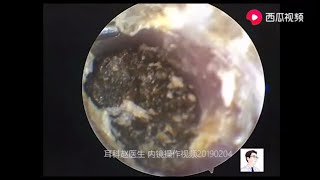 Dry cerumen and cholesteatoma 12 minutes [upl. by Krystyna223]