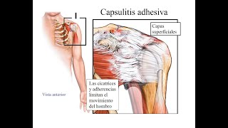 Capsulitis Adhesiva en hombro👉 Terapia  Rehabilitación [upl. by Larsen]