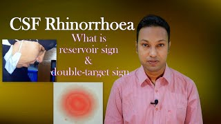 CSF Rhinorrhoea or Cerebrospinal Fluid Leak through Nose Signs Symptoms Diagnosis amp Treatment [upl. by Hodosh708]