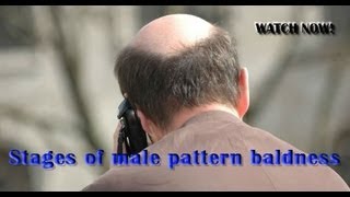 Stages of male pattern baldness [upl. by Midis696]