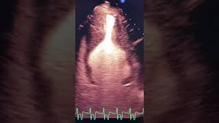 Yamaguchi Syndrome on Echo echocardiogram echocardiography cardiology [upl. by Eocsor]