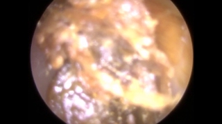 182 Retracted Umbo and Inflamed Eardrum visible post Ear Wax Removal  Mr Neel Raithatha THC [upl. by Radack218]