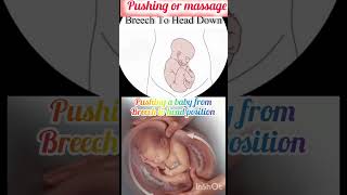 baby position changing from breech to head down  shorts subscribe [upl. by Lenehc]