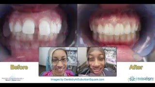 Invisalign Before amp After Slideshow [upl. by Nosemyaj]