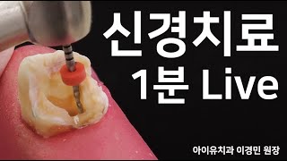 치통 심할때 하는 신경치료 크라운 과정 1분 Live [upl. by Ardnal]