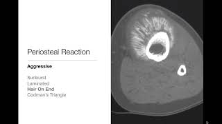 Bone Tumors  Periosteal Reaction  Radiology Basics [upl. by Kotto475]