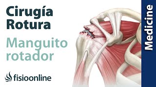 Lesión del manguito rotador  Qué es diagnóstico y tratamiento indicado en fisioterapia y cirugía [upl. by Tnert364]