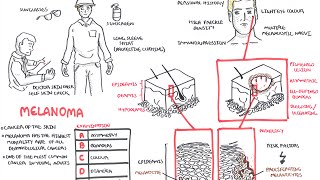 Melanoma  Overview signs and symptoms pathology risk factors treatment [upl. by Benoit]