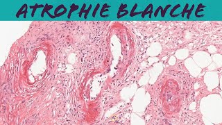 Atrophie blanche livedoid vasculopathy dermatology dermpath pathology [upl. by Balbur]