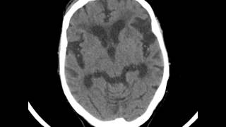 Periventricular Gliosis and Atrophic brain Head CT [upl. by Pauwles]