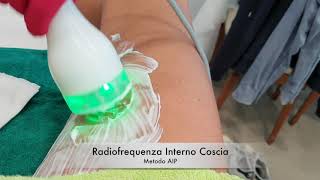 Radiofrequenza Interno Coscia  Metodo AIP [upl. by Warner718]