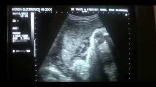 PLACENTA GRADE 1 and GRADE 2 ultrasound [upl. by Spanos49]