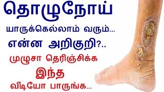 What Is Leprosy Symptoms Treatment Causes amp Prevention in Tamil  Rahul Health tips in Tamil [upl. by Leaw269]