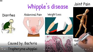 Whipples disease made easy Whipple disease symptoms treatment prognosis [upl. by Carey10]