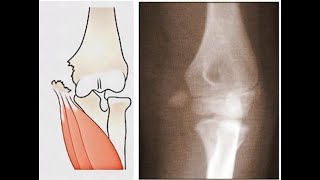 Displaced Medial epicondyle Fracture in ChildORIF [upl. by Asenaj]