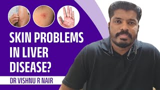 Skin Problems in Liver Disease   Dr Vishnu R Nair [upl. by Barbee]