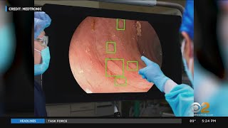 New AI helps detect potentially cancerous polyps in the colon [upl. by Taffy]