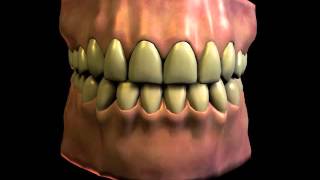 Dental Bruxism Teeth Grinding [upl. by Ainirtac]