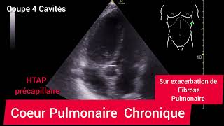 Coeur Pulmonaire Chronique HTAP Précapillaire Échographie [upl. by Oluap]