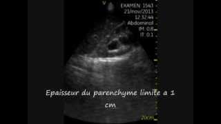 Hydronephrose severe Echographie de poche aux urgences [upl. by Millburn]