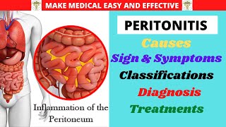 PERITONITIS Anatomy Causes Sign and Symptoms ClassificationsComplications DiagnosisTreatments [upl. by Hannad660]