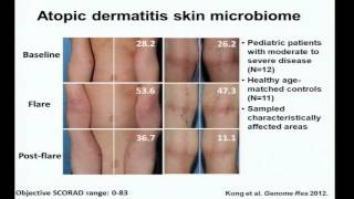 Eczema Immunity and the Skin Microbiome  Heidi Kong [upl. by Suiravaj]