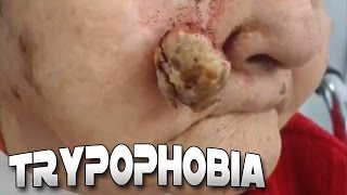 Cysts Blackheads Skin amp Trypophobia [upl. by Serafine]