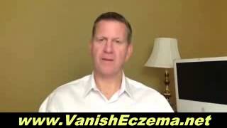 Vanish Eczema Ebook Review [upl. by Killigrew133]