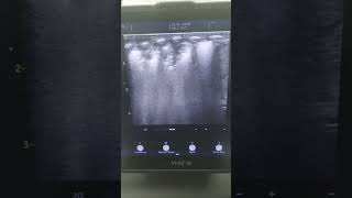 Neonatal Lung Ultrasound  showing collapse in post zones bilateral neonates pocus neonatology [upl. by Llehsyt]