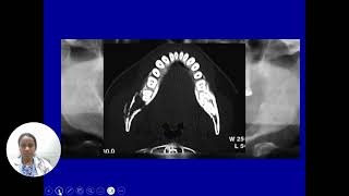 Osteomyelitis of the jaws by DR ANITHA [upl. by Drofyar]