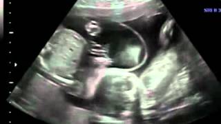 Twins in ultrasound21 weeks [upl. by Nydia]