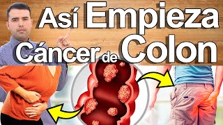 Así Empieza El Cáncer De Colon Y Nadie Lo Sabe  Signos Y Síntomas de Cáncer Que Debes Conocer [upl. by Gannes]