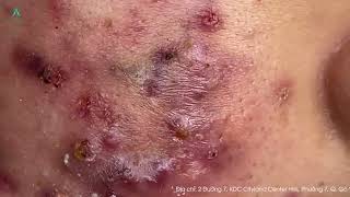 Big Cystic Acne Blackheads Extraction Blackheads amp Milia Whiteheads Removal Pimple Popping [upl. by Niwrek]