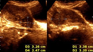 Three cases of Leiomyoma Uterus  Abnormal Uterine Bleeding  sonographic prediction [upl. by Thane378]