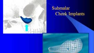 Submalar Cheek Implants with Dr Barry Eppley [upl. by Eelrahs517]