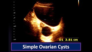 Understanding Simple Ovarian Cysts Ultrasound Findings  Ovarian Cyst  Simple follicular cyst [upl. by Rush]