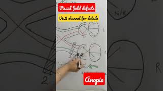 Visual field defect anopiashorts physiology eyes [upl. by Ivz]