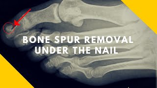 Bone Spur Under Big Toe Nail Subungual Exostosis [upl. by Ioyal]