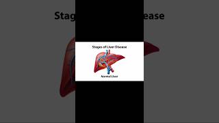 Stages of Liver disease  Fatty liver  Fibrosis Liver  cirrhosis Liver disease [upl. by Nosbig851]