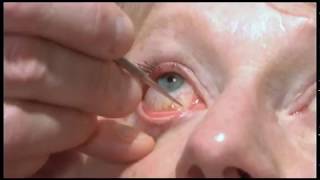 Oculoplastics basic exam Lacrimal system examination [upl. by Hnaht]