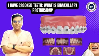 Dr Rudra Mohan  I Have Crooked Teeth What is Bimaxillary Protrusion Understand Treatment Options [upl. by Earla]