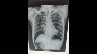 Peritonitis  pneumoperitoneum  chest x ray srivarihospital [upl. by Carmencita]