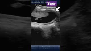 Normal Placenta  in Patient with Previous CSection pregnancy placenta ultrasound baby [upl. by Aniteb]