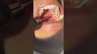 Upper third molar teeth extraction [upl. by Emelen]