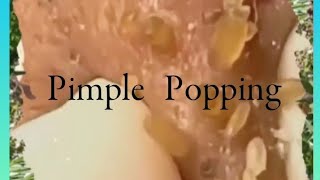 Pimple amp Blackheads Popping  38 [upl. by Jeralee]